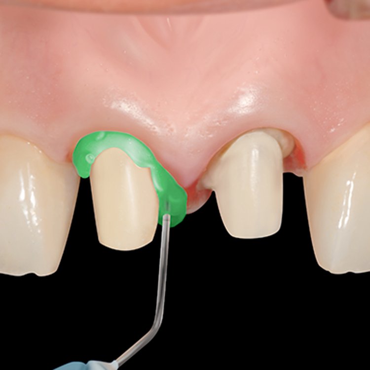 Retrax GEL AS PP (16-540) 2